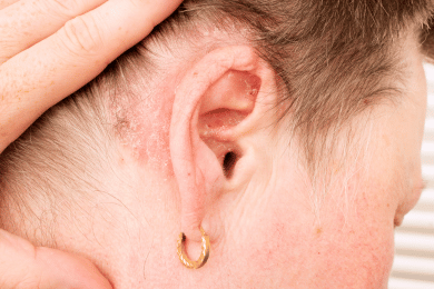 Eczéma aux oreilles que faire ?